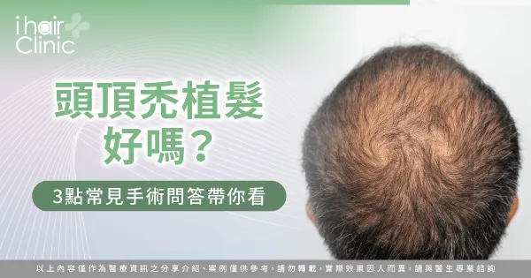  頭頂禿植髮3個QA全解析-頭頂禿 植髮