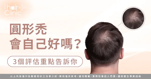 3個重點告訴你圓形禿的治療建議-圓形禿會自己好嗎