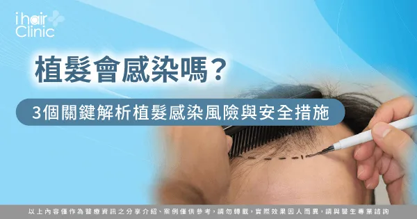 植髮會感染嗎-植髮 感染