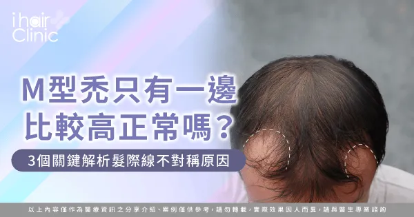 M型禿只有一邊比較高-M型禿不對稱