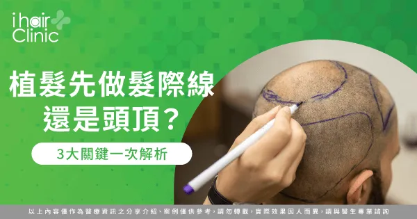 植髮規劃先做髮際線還是頭頂-植髮 髮際線 頭頂