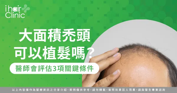 大面積禿頭可以植髮嗎-大面積禿頭植髮 效果