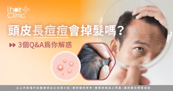  3個問答解析頭皮冒痘與掉髮的關聯-頭皮長痘痘 掉髮