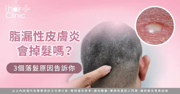 脂漏性皮膚炎3點落髮原因一次看-脂漏性皮膚炎會掉髮嗎