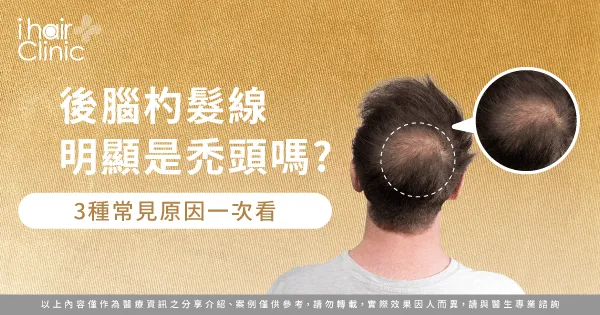  後腦杓髮線明顯3大原因全解析-後腦杓髮線明顯
