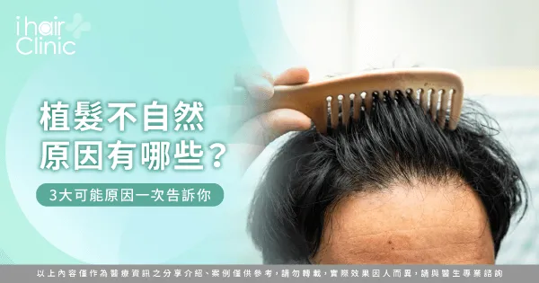  植髮不自然原因是什麼？3大手術重點一次報你知