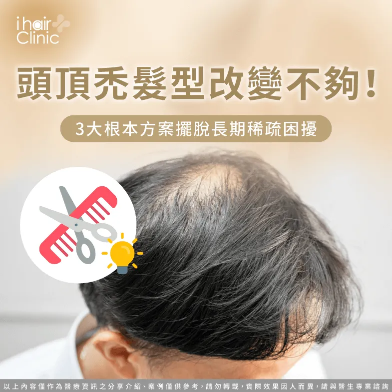  頭頂禿髮型-頭頂稀疏髮型