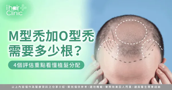 M型禿加O型禿需要多少根-M型禿 O型禿 植髮