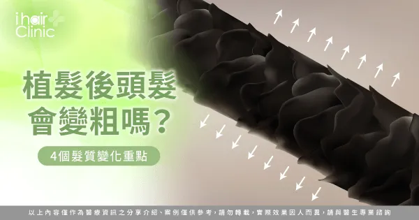 植髮後會和原本頭髮一樣粗嗎-植髮 頭髮 粗細