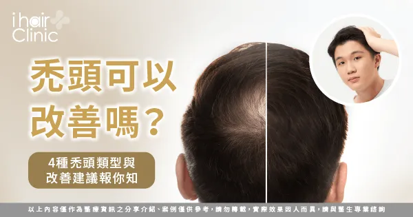  4種禿頭類型與改善建議全解析-禿頭 可以 改善 嗎