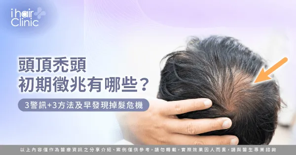 頭頂禿頭初期徵兆有哪些-頭頂禿頭 徵兆