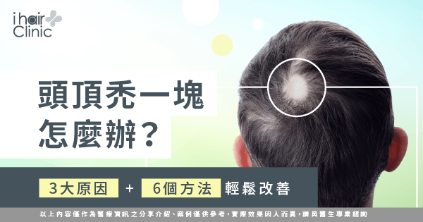 3大原因及6個改善方法-頭頂 禿一塊