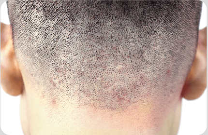 肌膚敏感者-trivellini適合對象-新竹植髮推薦