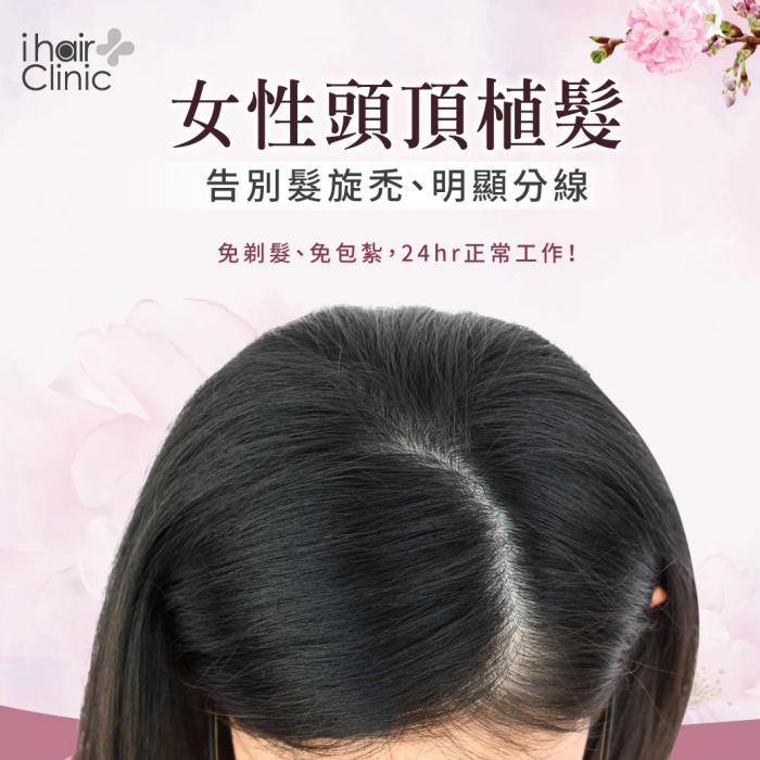 女性頭頂植髮-新竹植髮推薦