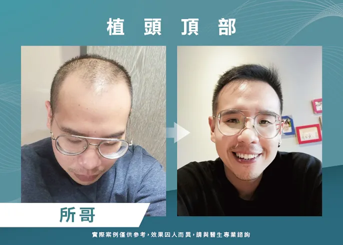 案例分享男性頭頂部植髮-新竹植髮推薦