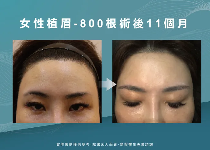 女性植眉11個月-新竹植眉推薦