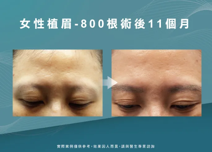 女性植眉術11個月-新竹植眉推薦