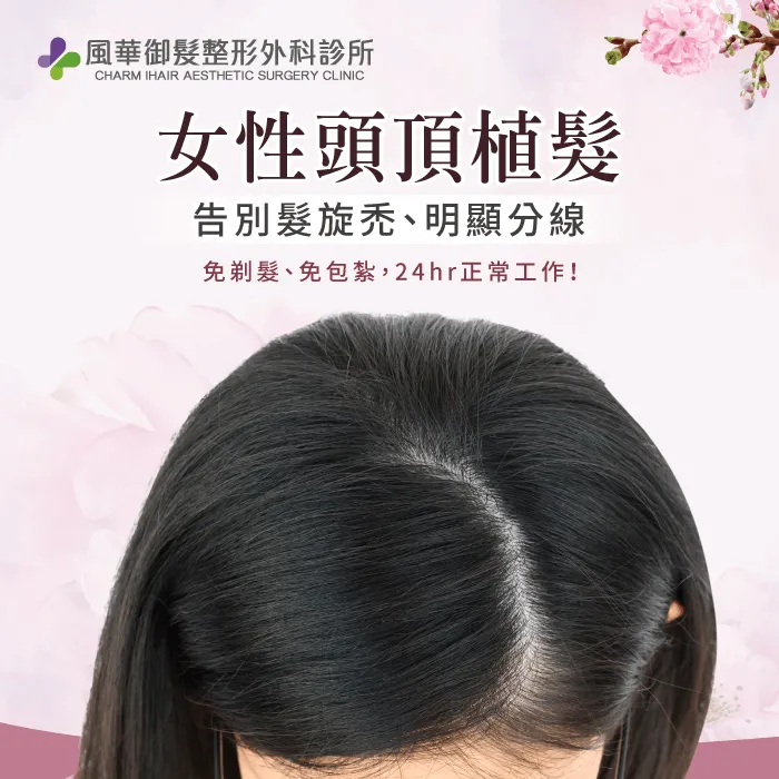 女性頭頂植髮-新竹植髮推薦