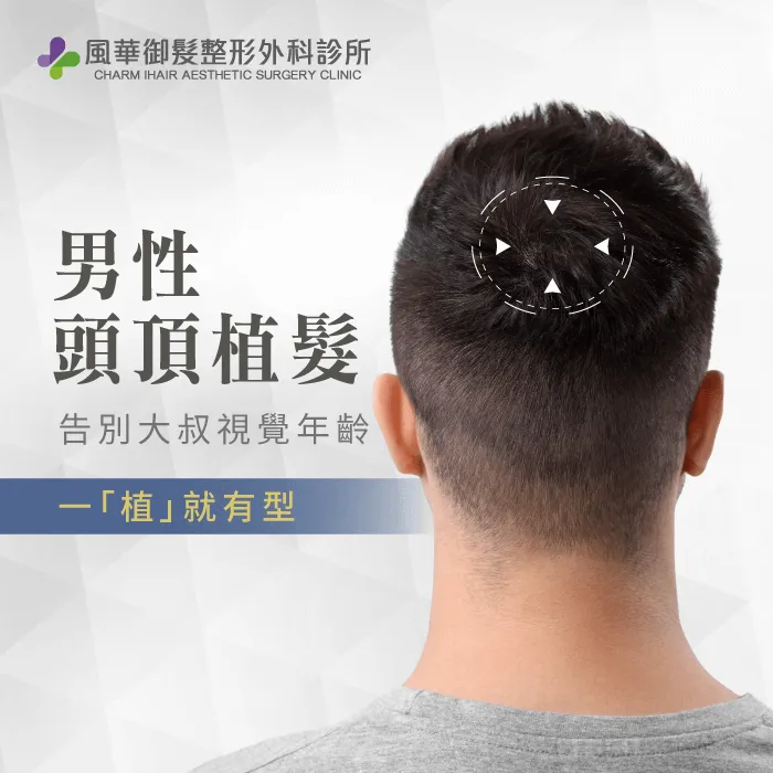 男性頭頂植髮-新竹植髮推薦