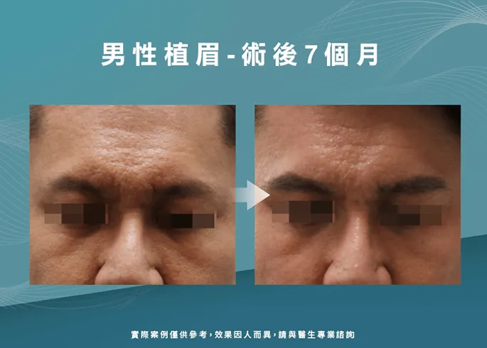 男性植眉成果-新竹植眉推薦