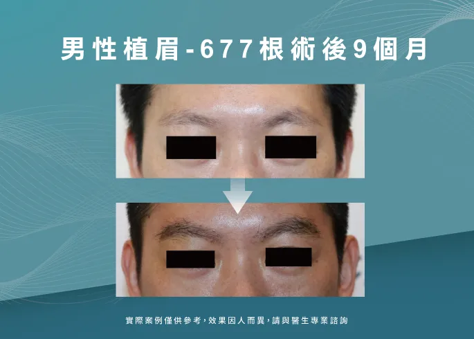 男性植眉9個月-新竹植眉推薦