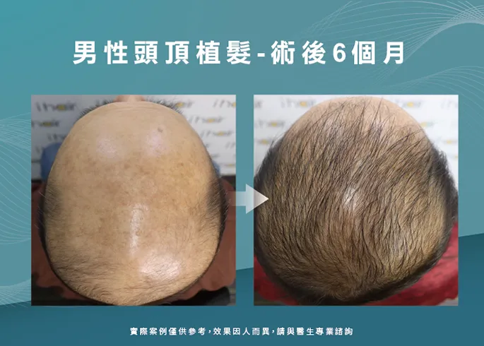 案例分享男性頭頂部植髮-新竹植髮推薦