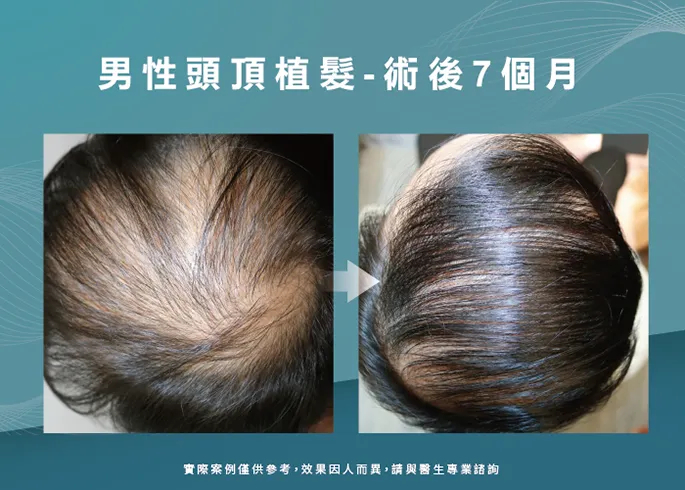 案例分享男性頭頂部植髮-新竹植髮推薦