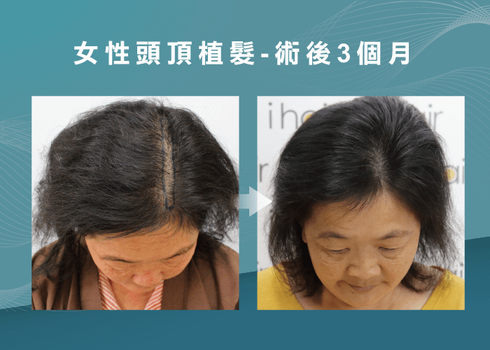 女性頭頂植髮見證-新竹植髮推薦
