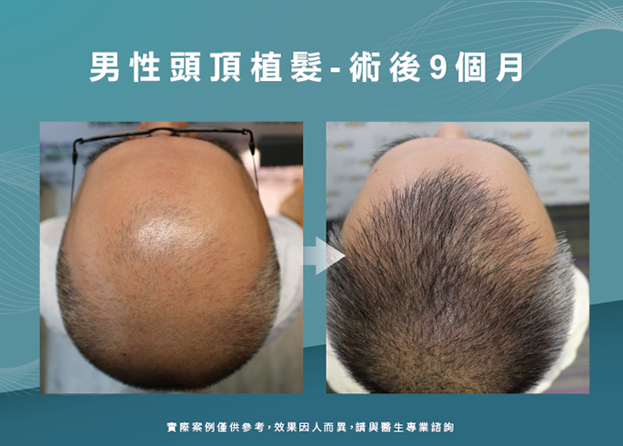 案例分享男性頭頂部植髮-新竹植髮推薦
