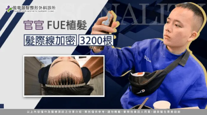 FUE髮際線植髮-新竹植髮推薦