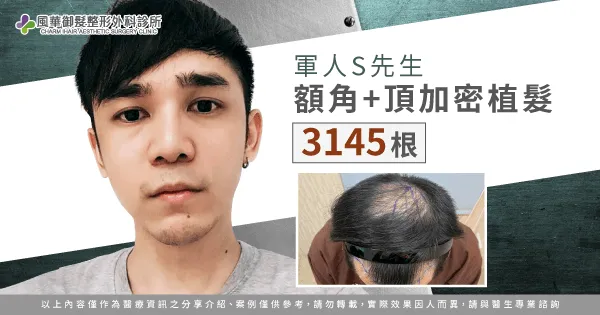 S先生男性植髮體驗-男性植髮