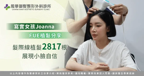 女性植髮際線-新竹女性植髮推薦