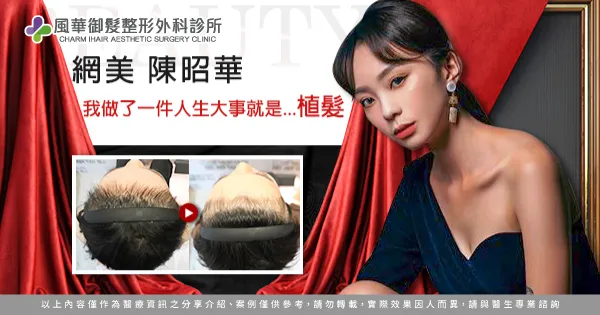 網美陳昭華女性植髮體驗-女性植髮