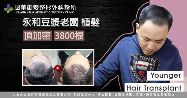 FUE巨量植髮-新竹植髮推薦