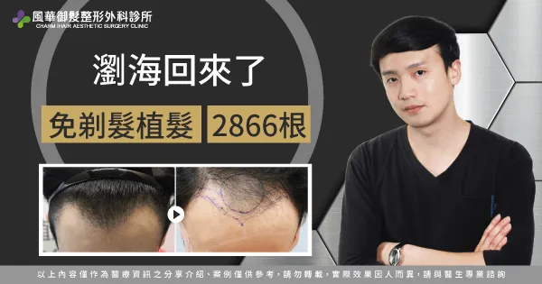 免剃髮植髮-新竹植髮推薦