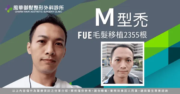 FUE植髮-新竹植髮推薦