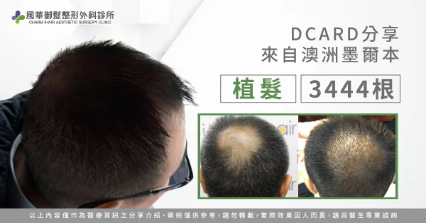 華僑植髮-地中海禿頭植髮