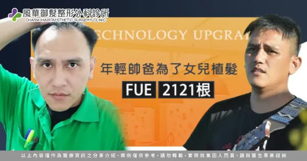 M型禿植髮-新竹植髮推薦