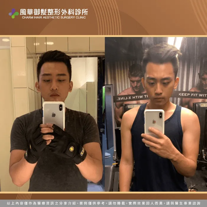 植髮後生活照分享-新竹植髮推薦