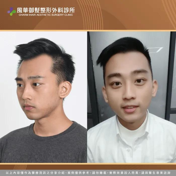 M型禿植髮-新竹植髮推薦