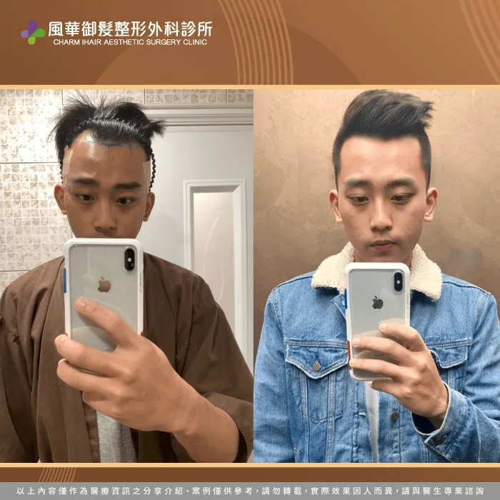 M型禿植髮檢測-新竹植髮推薦