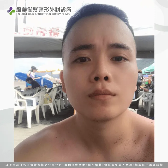 25歲的官官,一直深厚髮際線過高的困擾,想透過植髮手術拾回自信! FUE髮際線植髮-新竹髮際線植髮