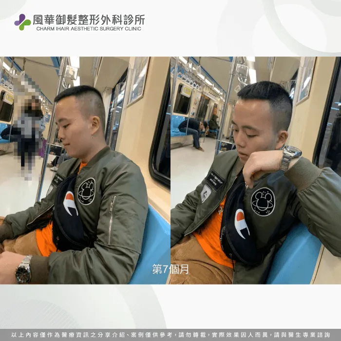 ihair風華御髮診所為官官規劃2次,共3200根的髮際線植髮! 經過3200根植髮手術恢復後-新竹植髮推薦