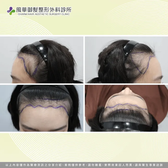 手術前髮量-新竹女性植髮推薦
