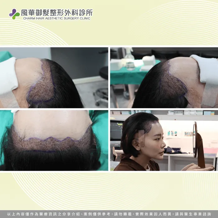 毛囊種植完成-新竹女性植髮推薦