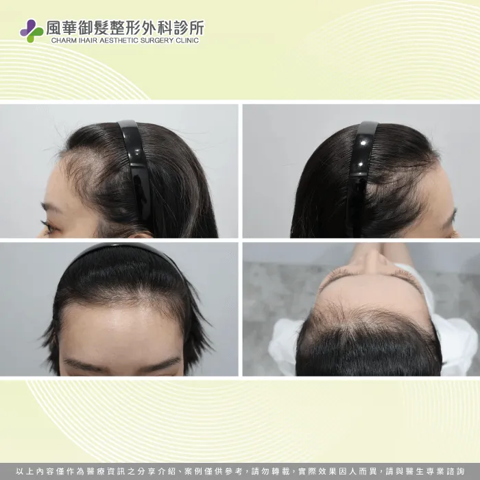 植髮填補區域畫線-新竹女性植髮推薦