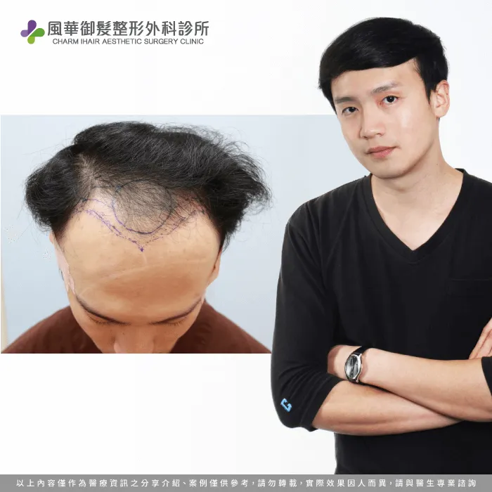 B先生植髮效果-新竹植髮推薦