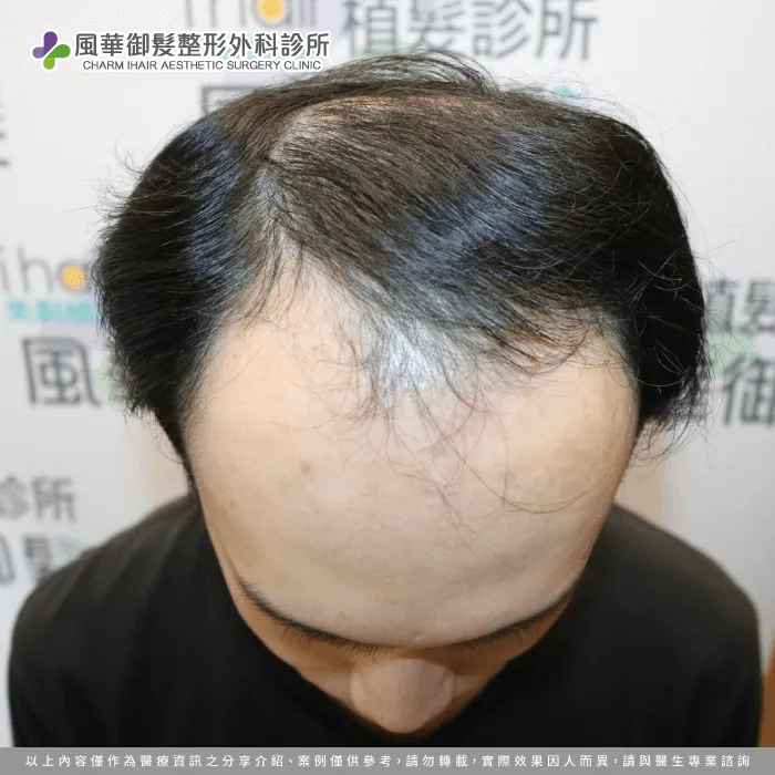B先生的禿髮情形-免剃髮植髮