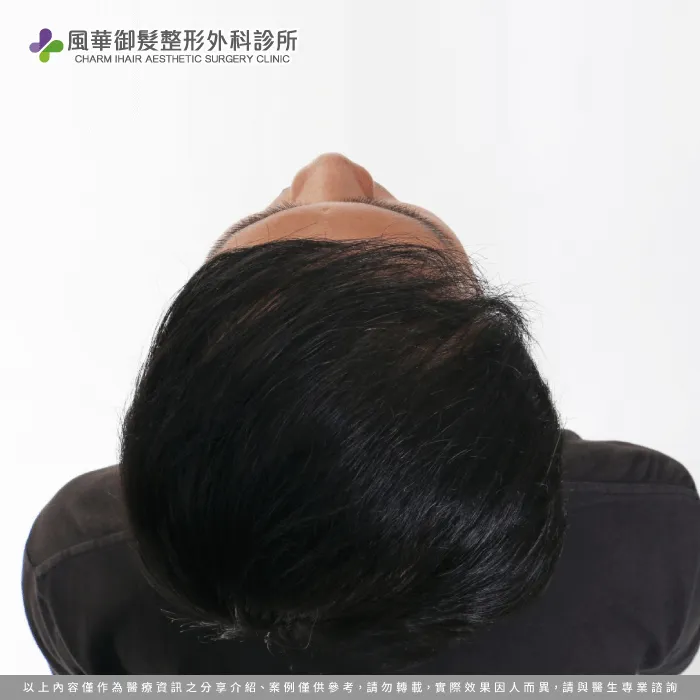 B先生前額落髮較為嚴重-免剃髮植髮
