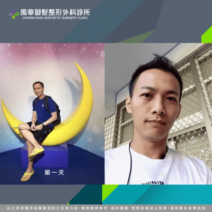 植髮第一天到第一個月-M型禿植髮
